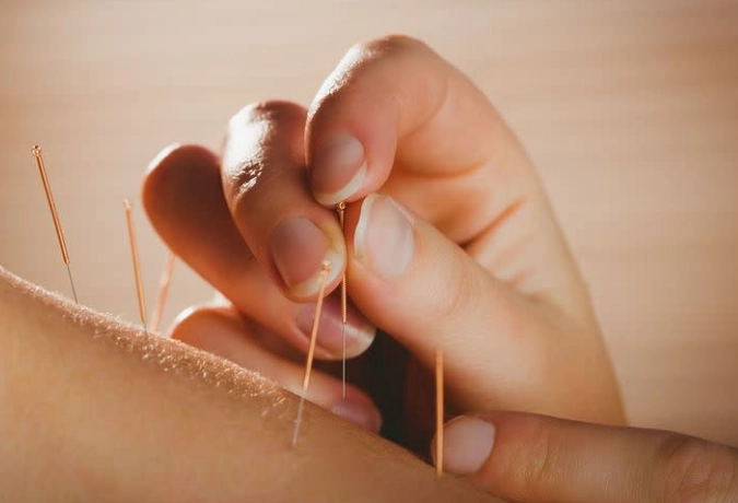 胃食道逆流針灸有效嗎？科學實證與治療全攻略
