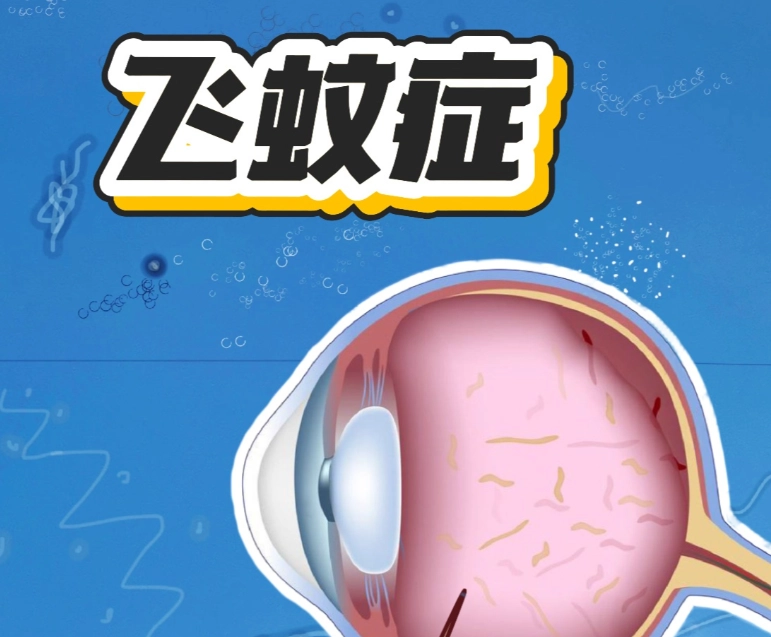 飛蚊症的治療小偏方