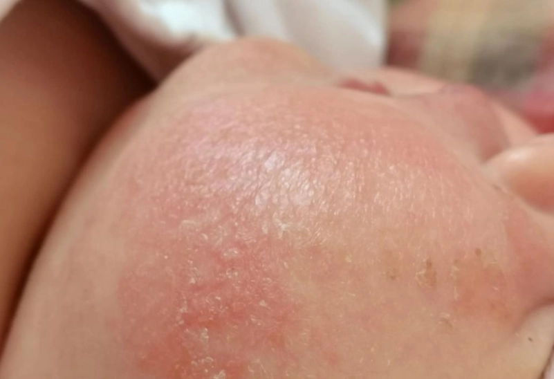 脂漏性皮膚炎嬰兒乳液