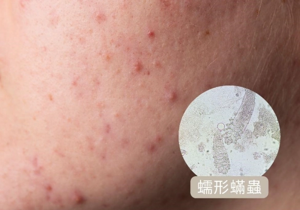 蠕形蟎蟲治療多久