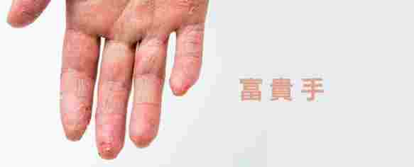 富貴手怎麼治療