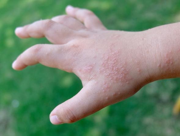 手指長小水泡很癢